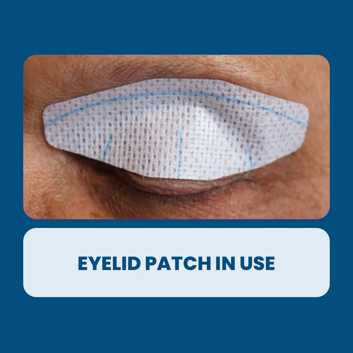 Nictavi Disposable Device for Nighttime Eye Lid Closure (15ct) - Image 3
